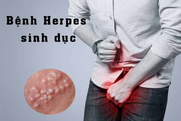 Bệnh lý Herpes sinh dục thường xuất hiện ở nhiều ở nam giới