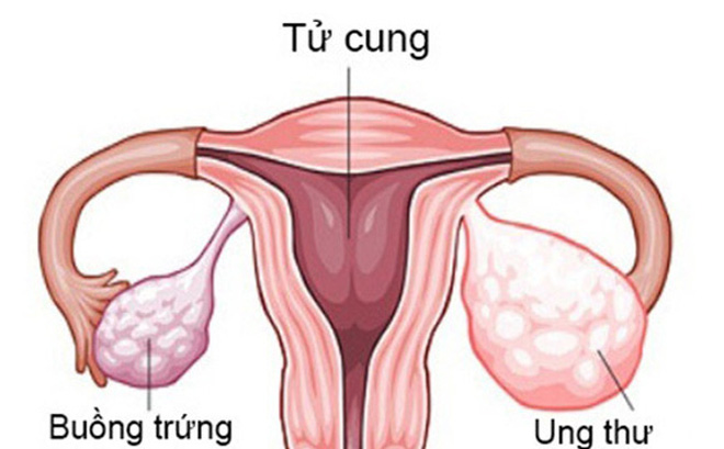 Hình ảnh về buồng trứng của phụ nữ