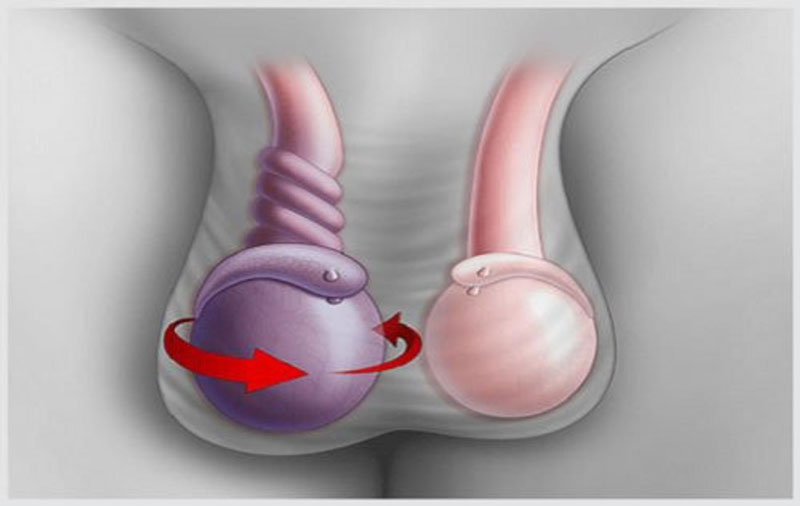 Xoắn tinh hoàn gây đau một bên vùng bụng dưới và vùng tinh hoàn