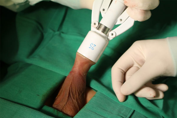 Sử dụng tia laser để cắt bao quy đầu là một phương pháp ngoại khoa mới.